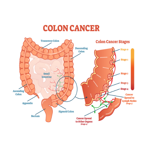 Colon Cancer